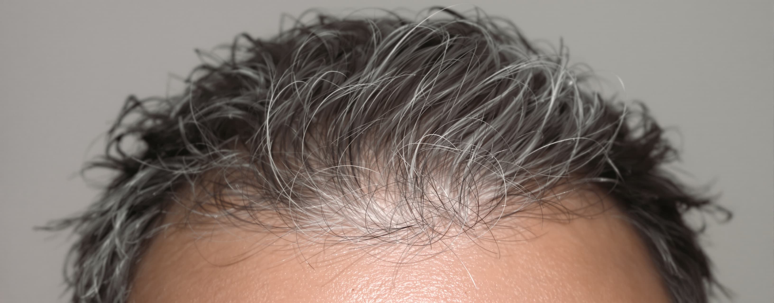I noticed my first white hair when I was 18-19. With time I ...